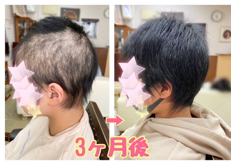 オシャレ 抜毛抑制ウィッグ | giulianacividanes.com.br